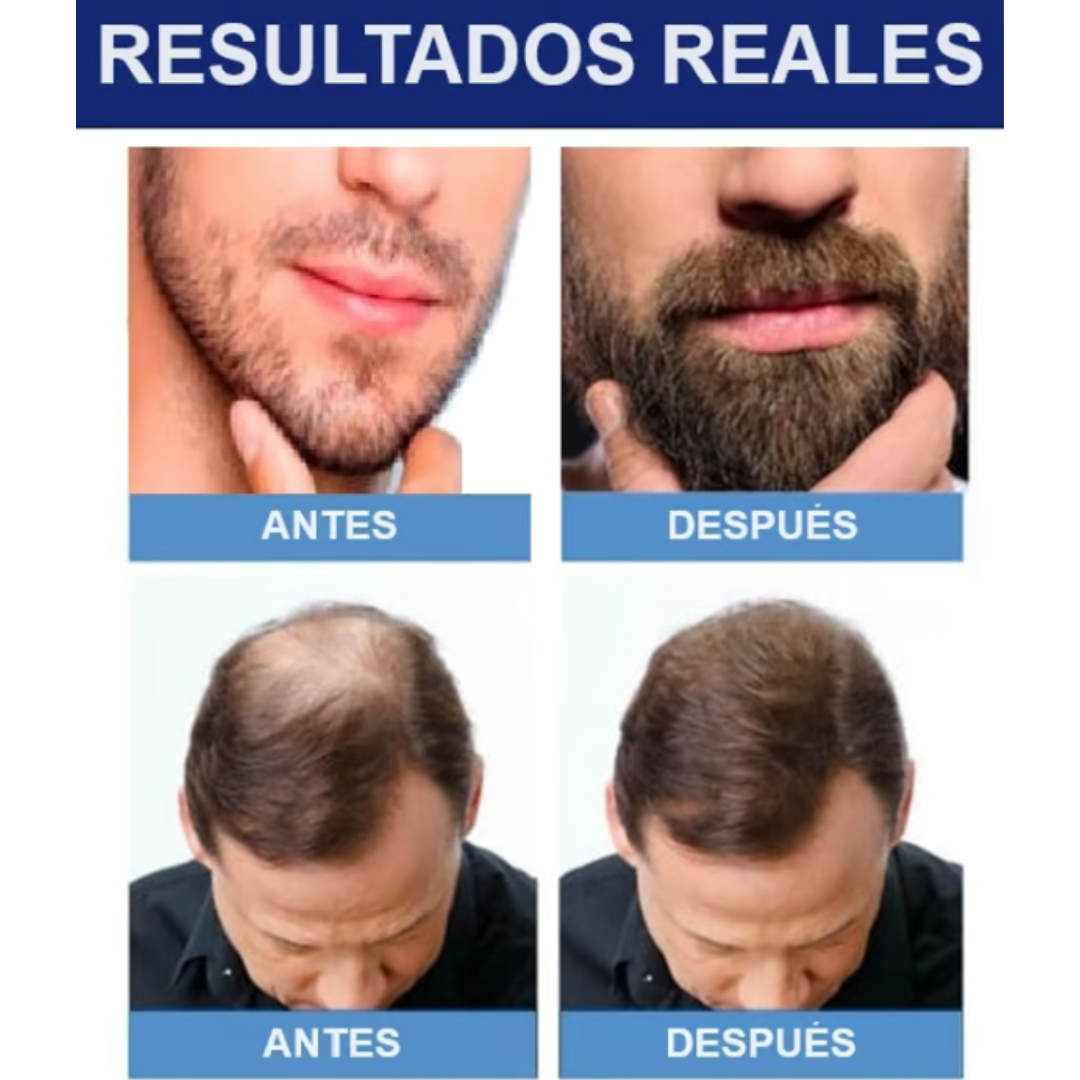 Descubre el Secreto para Combatir la Calvicie de Forma Efectiva (Minoxidil KIRKLANDS 5%)60ML